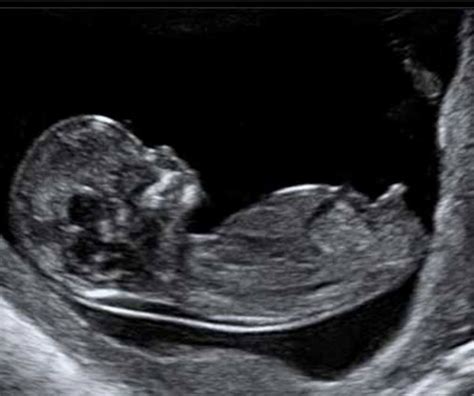 dating scan accuracy at 6 weeks